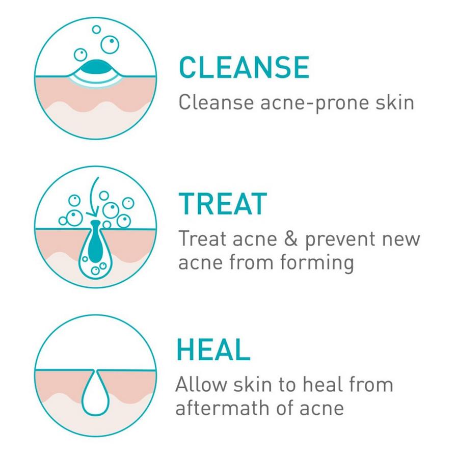 CeraVe® Acne Foaming Cream Cleanser with 4% Benzoyl Peroxide - 150ml