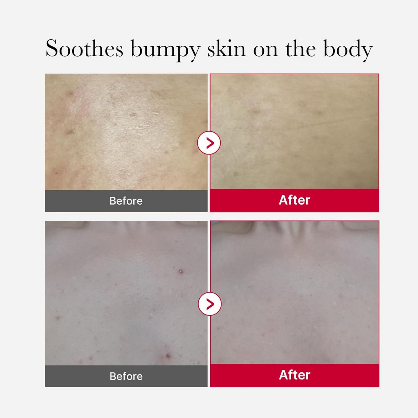 MEDICUBE Red Acne Body Peeling Shot - 110g