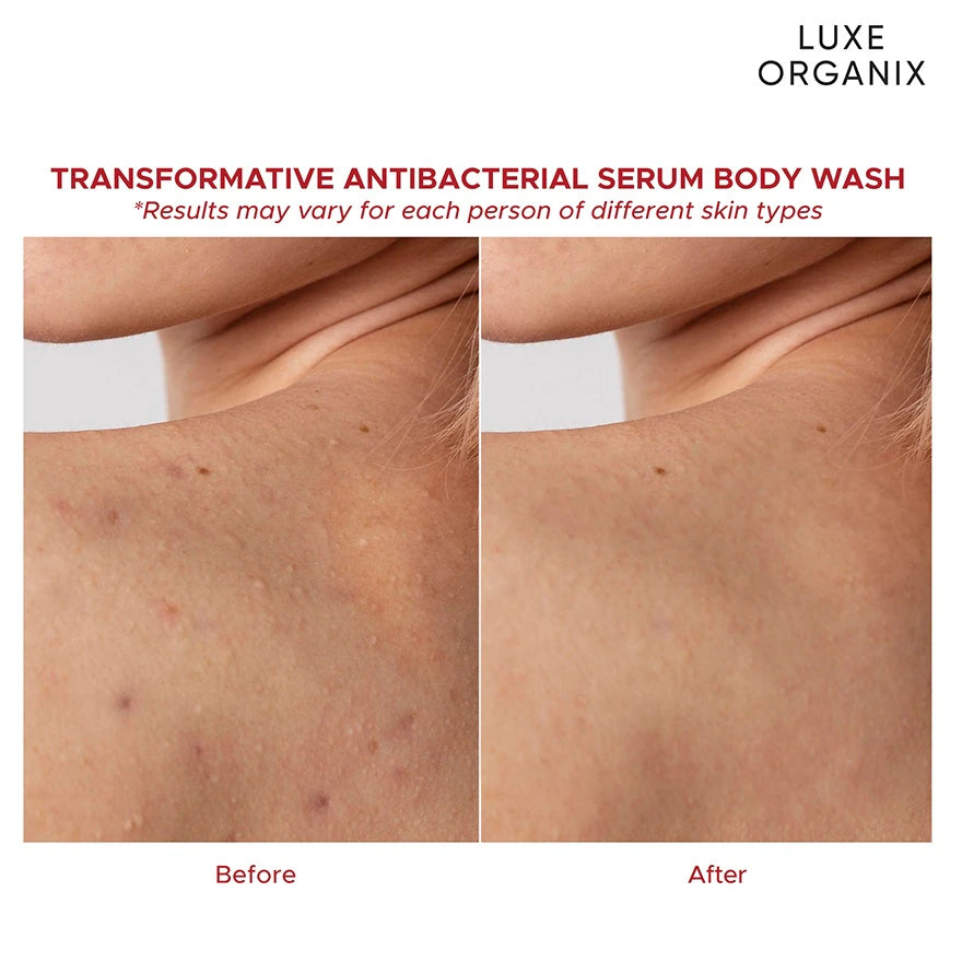 LUXE ORGANIX Dermapro Salicylic Acid 2% Acne Rescue Body Wash - 500ml