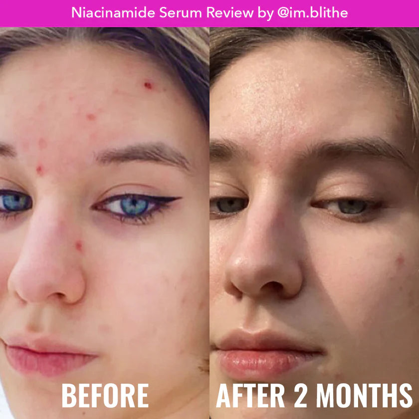 Niacinamide 10% Serum - 30ml