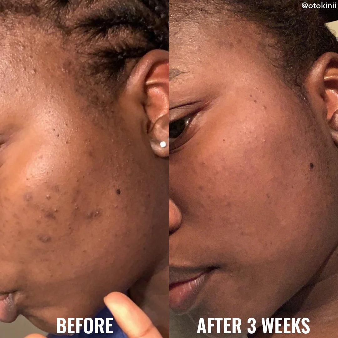 Discoloration Correcting Serum - 30ml