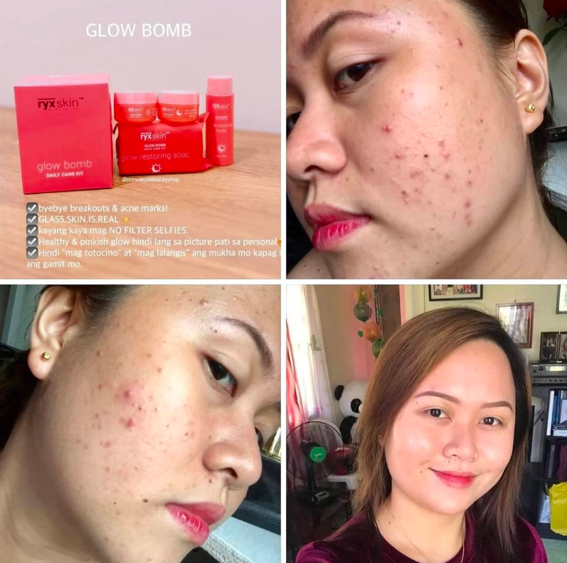 RYX Skin Glow Bomb Advanced Exfoliating Kit – ibeautyspot